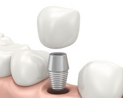 dental_implants_1 Alma, MI Dentist | Mid-Michigan Dental Excellence